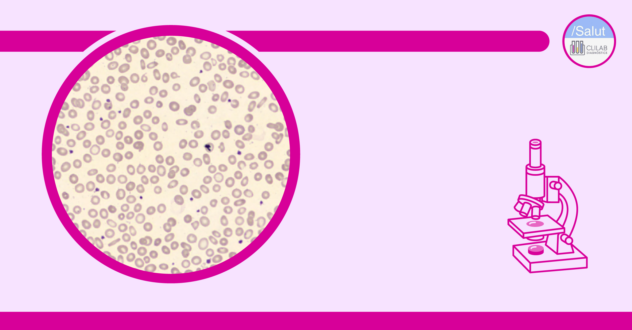 Frotis de sangre periférica que muestra anisocitosis con microcitosis, hipocromía y eliptocitos