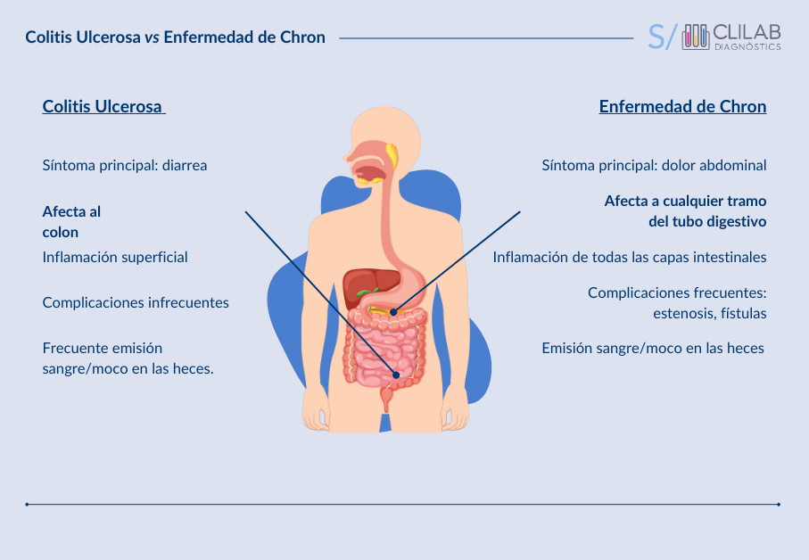 Colitis Ulcerosa y enfermedad de Chron