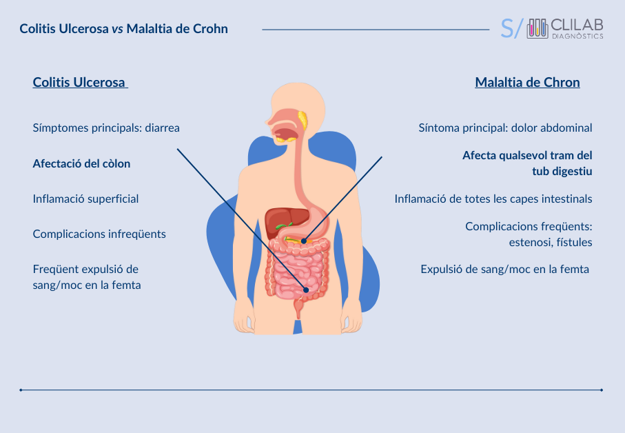 Colitis Ulcerosa i malaltia de Chron